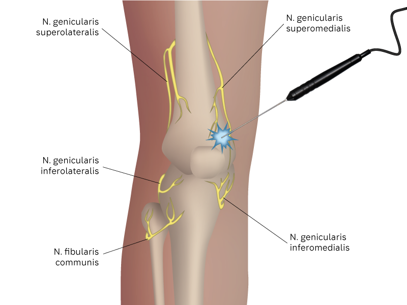 Illustration: Positionierung der Kryosonde am Nerv Illustration: Positionierung der Kryosonde am Nerv